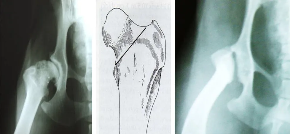 Radiografía de cadera, esquema del corte de la cabeza femoral y radiografía posquirúrgica
