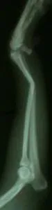 Radiografía de antebrazo de un perro miniatura con fractura de radio y ulna