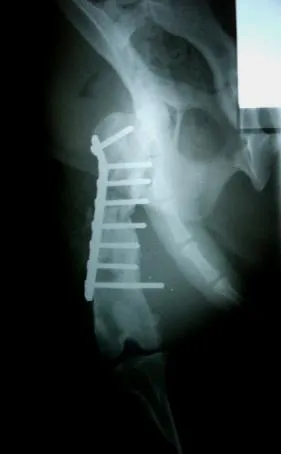 Radiografía de fémur reparado con placa y tornillos