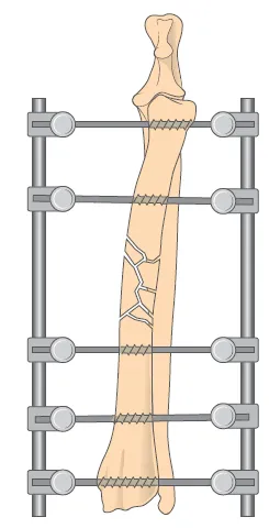 Esquema de fijador esquelético externo: clavos que atraviesan el radio fracturado unidos a dos barras laterales