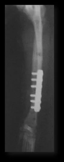 Radiografía de radio reparado con placa y tornillos