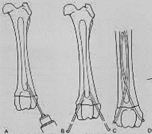 Esquema de clavos de Rush en el extremo distal del fémur