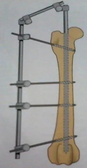 Esquema de un fijador tied in en el fémur