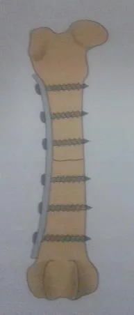 Radiografía de fémur reparado con placa y tornillos