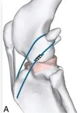 Esquema de la sutura lateral colocada en la rodilla