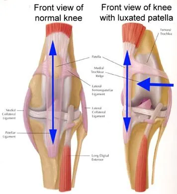 Rodilla normal comparada con una rodilla con la patela luxada