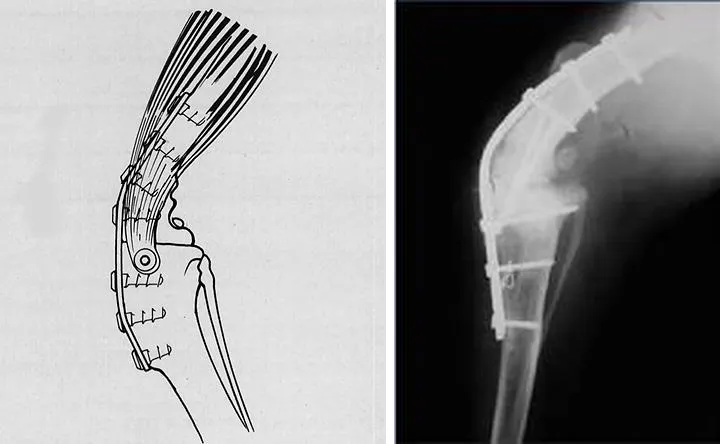 Ilustración y radiografía de una rodilla fijada con placa en artrodesis