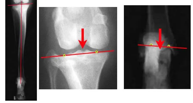 Radiografías de tibia con las líneas de referencia trazadas sobre la articulación