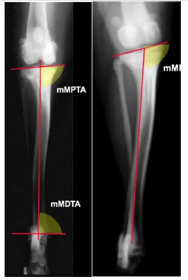 Dos radiografías de tibia con ángulos mediales marcados: una normal y otra con varo