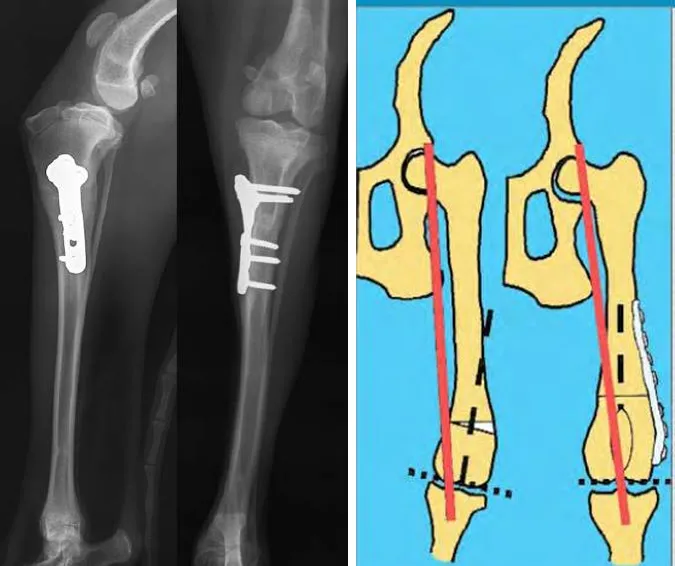 Radiografías de tibia con placa y tornillos y esquema de la corrección del eje del hueso