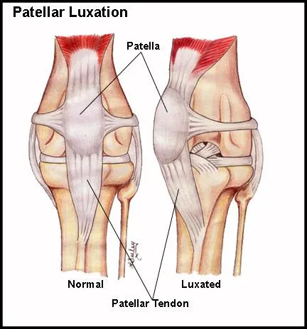 Ilustración de rodilla normal y rodilla con luxación de patela