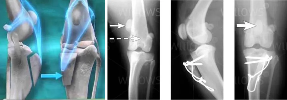 Ilustración y radiografías de la transposición de tuberosidad tibial fijada con clavos
