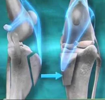 Ilustración de la rodilla mostrando el desplazamiento de la tuberosidad tibial