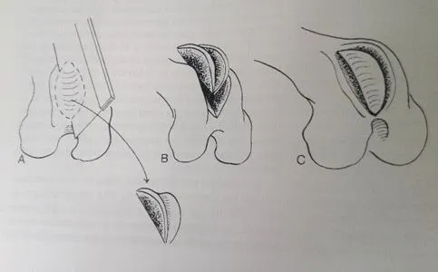 Ilustración de la trocleoplastía: profundización del surco troclear del fémur