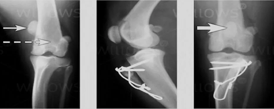 Radiografías de rodilla antes y después de la transposición de tuberosidad tibial