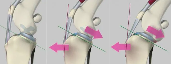 Esquema de rodilla con ruptura de ligamento cruzado craneal