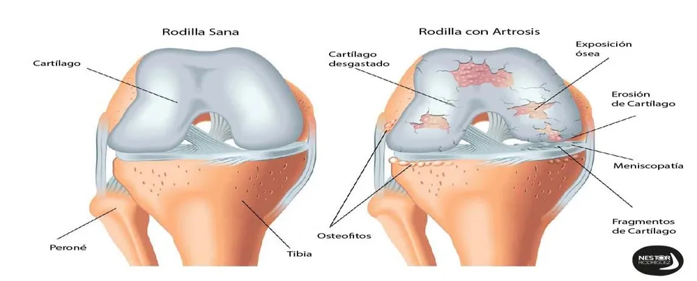 Comparación entre una rodilla sana y una rodilla con artrosis: cartílago desgastado, osteofitos y fragmentos de cartílago