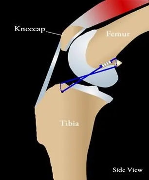 Esquema lateral de rodilla con sutura lateral que une el fémur con la tibia