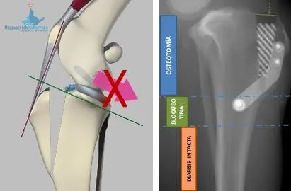 Esquema de la técnica TTA y radiografía de tibia con el implante colocado